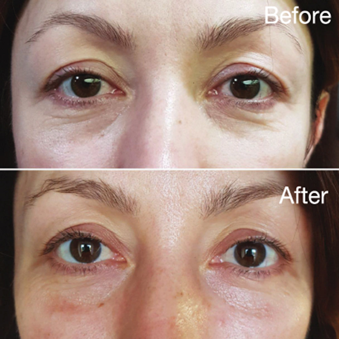 VITARAN I (2 x 1ml) Polynucleotide Injectable