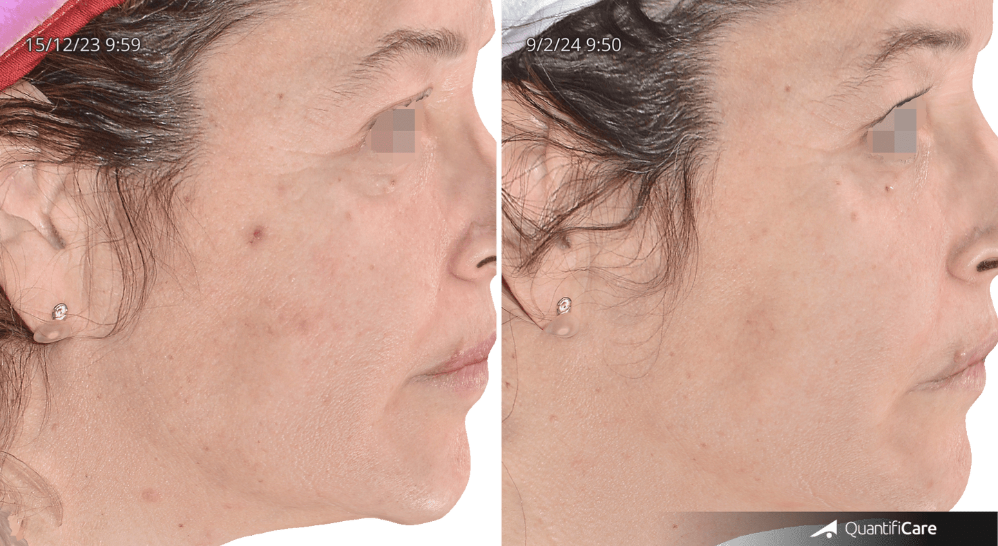 Inno Exoma EXO Skin 10ml (2ml x 5) – Advanced Exosome Skin Rejuvenation