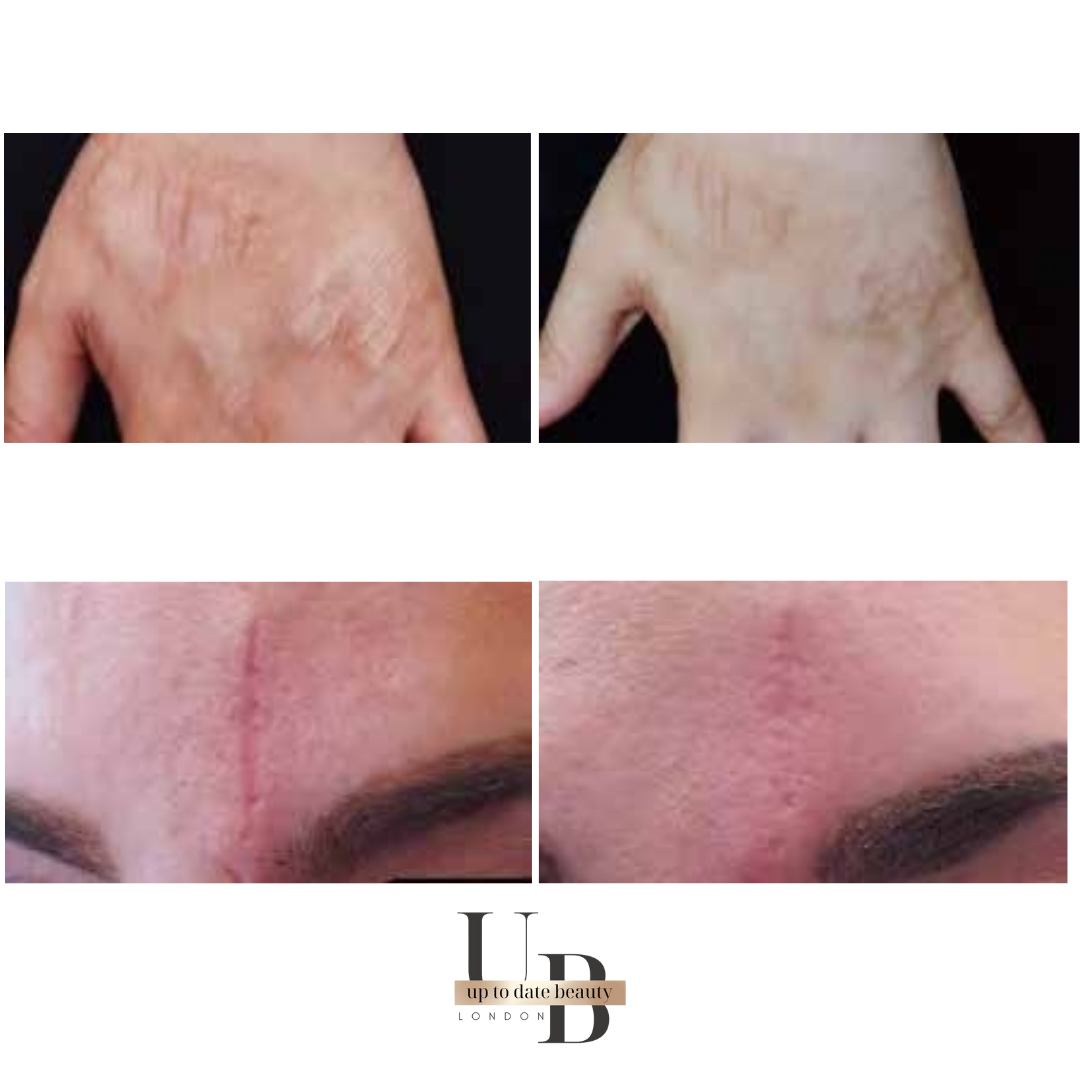 Portable RF Microneedling Machine - RejuTech®