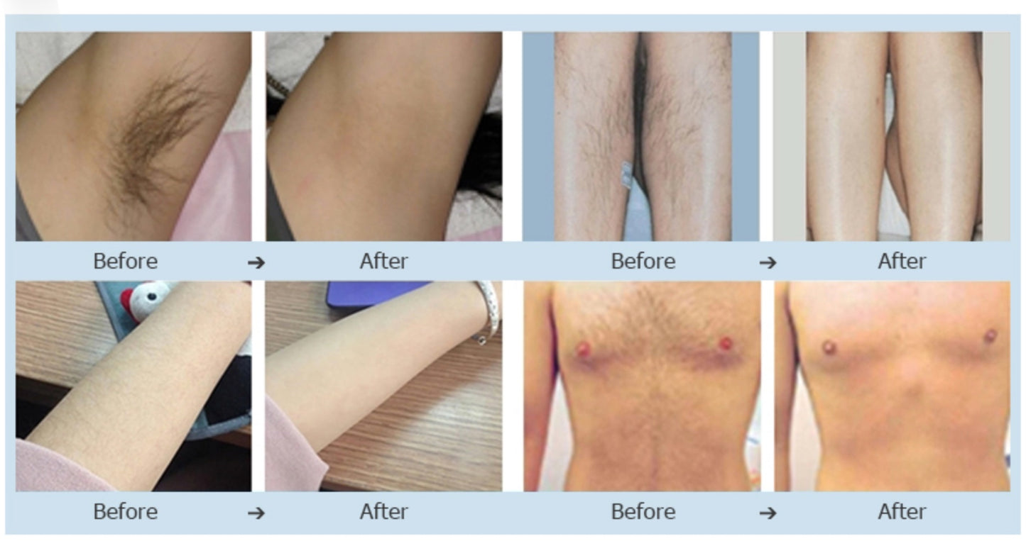 RejuTech® Laser Hair Removal - Request for quote